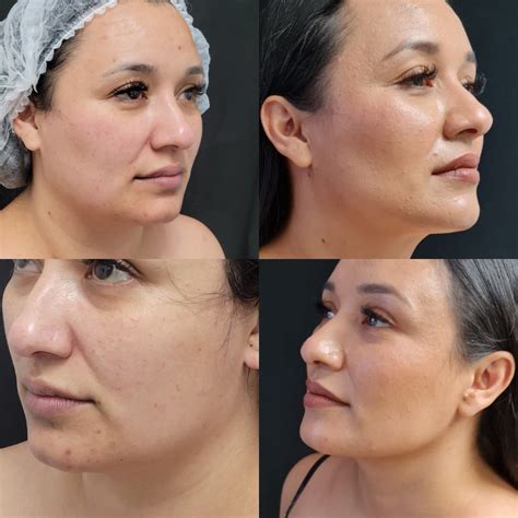 SUCCESS STORIES - Guerrero Plastic Surgery