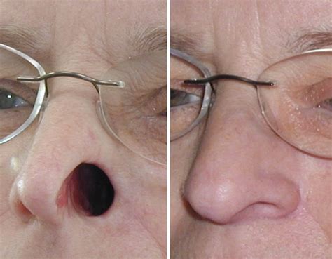 nasal prosthesis prosthetic nose wisconsin life  prosthetics