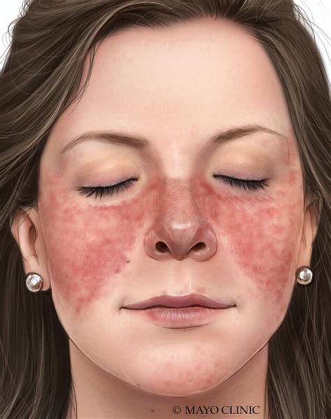 Lupus - Symptoms & causes - Mayo Clinic