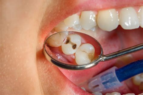 Dental filling: types and everything you need to know