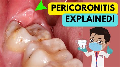 PERICORONITIS EXPLAINED IN 5 MINUTES! CAUSE, SYMPTOMS, DIAGNOSIS AND ...