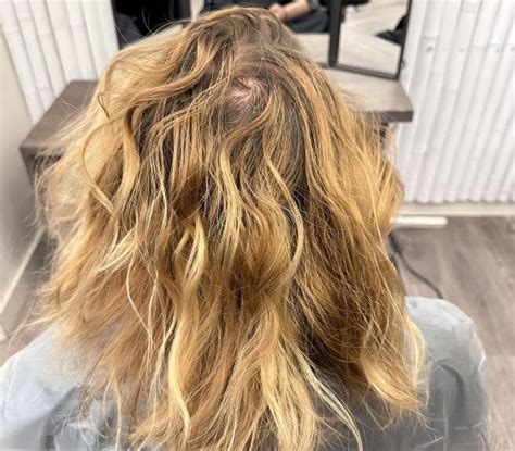 My hair is so thin I can see my scalp!Why & What to do？