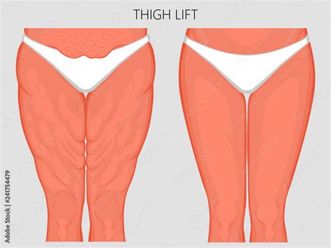 vector illustration   human body problem fatty thighs  sagging
