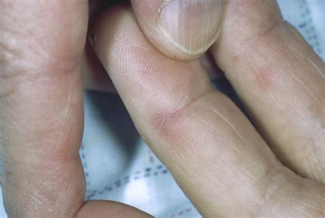 Endocarditis physical examination - wikidoc