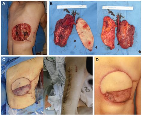 anterolateral thigh chimeric flap  alternative reconstructive option