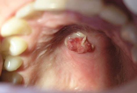 Clinical appearance: an exophytic pedunculated lesion with ...