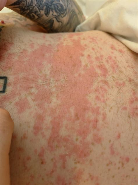 Any advice for creams? : r/eczema