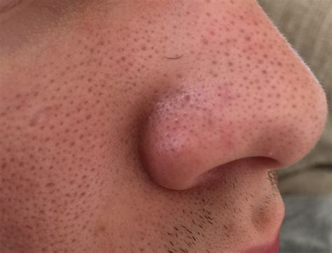 1 best u/freakpores images on Pholder | [Skin Concerns] What's wrong