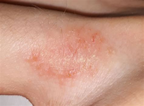 Atopic Dermatitis (ICD-10: L20) - Online consultation AI dermatologist