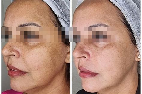 Laser Solon Antes E Depois - Antes e depois do Laser Lavieen