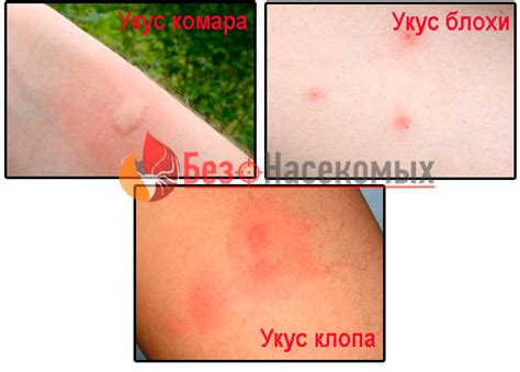Чем убрать укус клопа