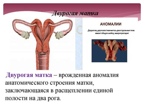 Аномалии развития матки - презентация онлайн