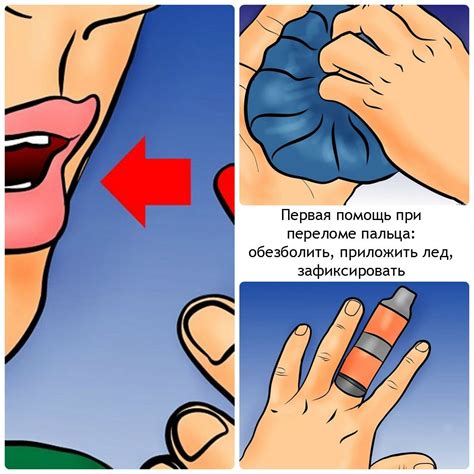 Перелом пальца на руке: симптомы, первая помощь и лечение