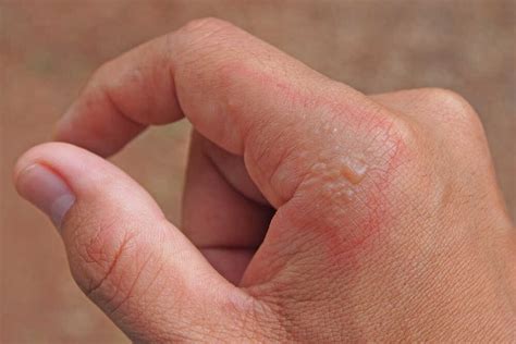 Impétigo en adultos: causas y cómo eliminarlo | Aloe Plus