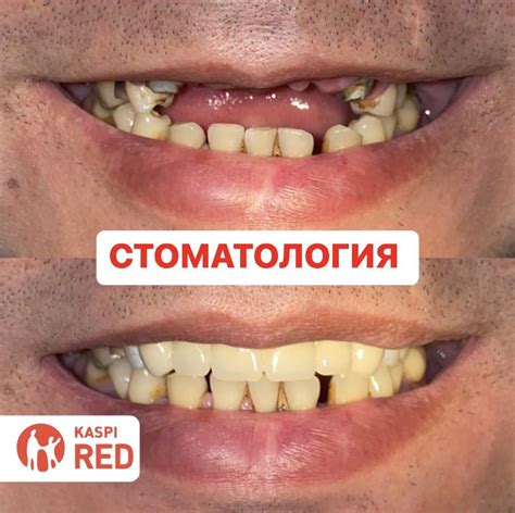 Стоматология протезы. Протезирование зубов. Коронки. Металакерамика ...
