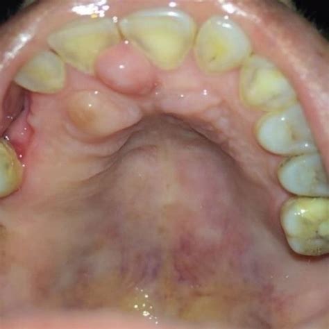 Oral Neurofibromas along hard palate 11,21 and 11,12. | Download