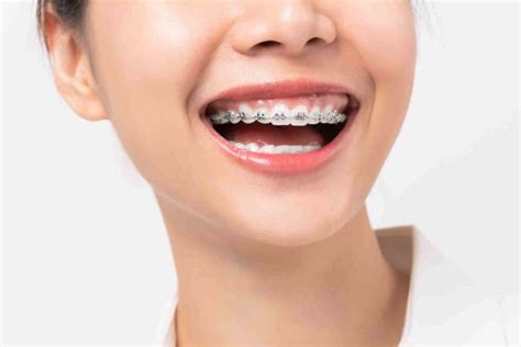 Can Braces Fix an Overbite?