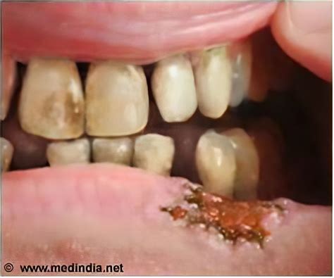 Chewing Tobacco Mouth Cancer Images at Carrie Alston blog