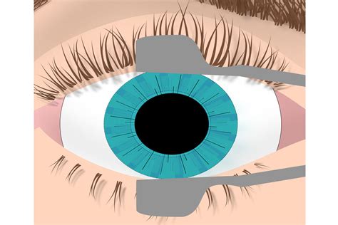 refractive surgery ratnam superspeciality eye hospital rajajipuram