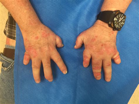 mucosal candidal infections - Next Steps in Dermatology