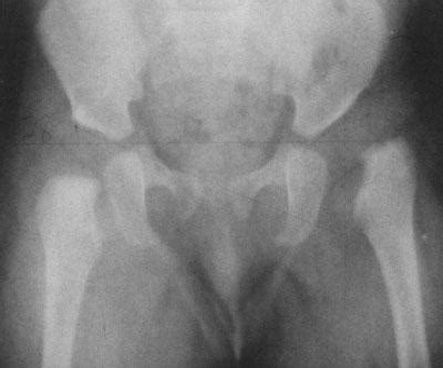 developmental dysplasia   hip ddh orthopedics medbullets