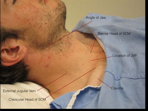 Jugular Venous Pulse Flashcards | Quizlet