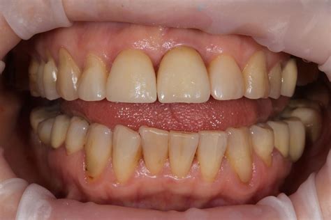 Циркониевая коронка на имплантант, винир на зуб - dentalhit
