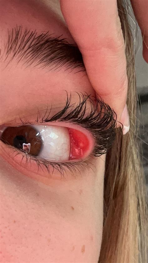 Pimple(?) in eye, help : r/lashextensions