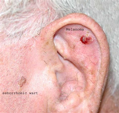 nodular melanoma size