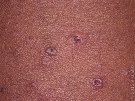 chickenpox     rare goodrx