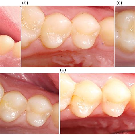 (a) Tooth 15 MOD (SBU/FZXT) preoperative. (b) Tooth 15 MOD (SBU/FZXT ...