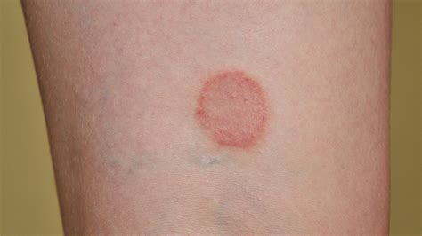 Ringworm: Symptoms, Pictures, Causes, Treatment, & More - GoodRx
