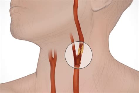 Stenoza arterelor carotide - cauze, simptome, tratament - Spitalul ...