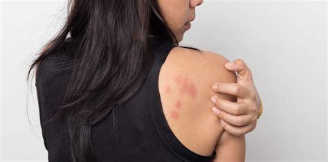 Stress Eczema: Causes, Symptoms and Treatment Options