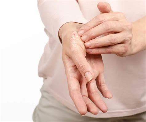 Psorijaza - kako ju pravilno liječiti? eDoktor