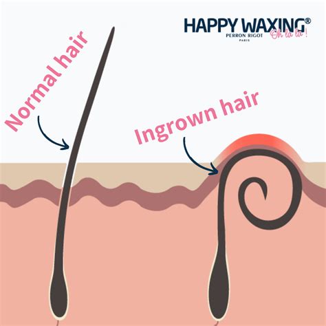 prevent ingrown hairs  waxing happy waxing