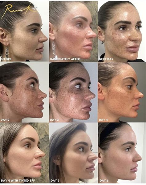 Laser skin rejuvenation – Golden Aesthetics