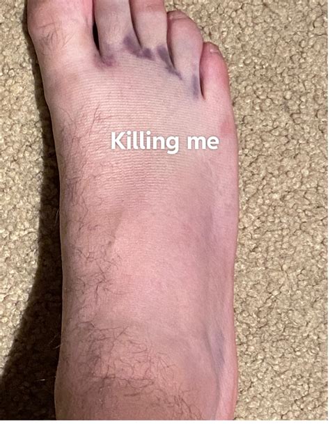 Broken foot : r/brokenbones