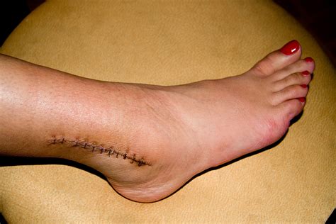 Foot Surgery | Dr. Gary Evans