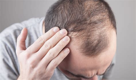 Male-Pattern Baldness: What Can You Do About It? - SelfDecode Health