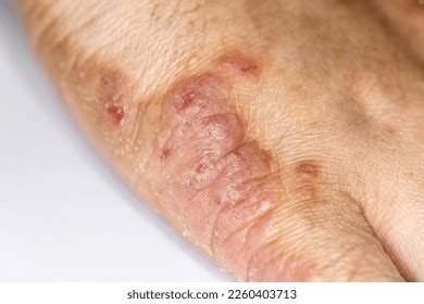 Стоковая фотография 2260403713: Background Human Skin Dust Mite Allergy ...
