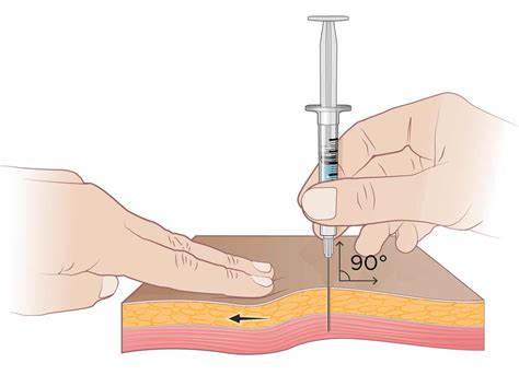 track injection definition  patient education