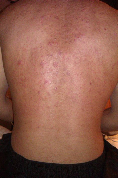 My boyfriend is allergic to sunscreen. (He already posted to wtf) : r