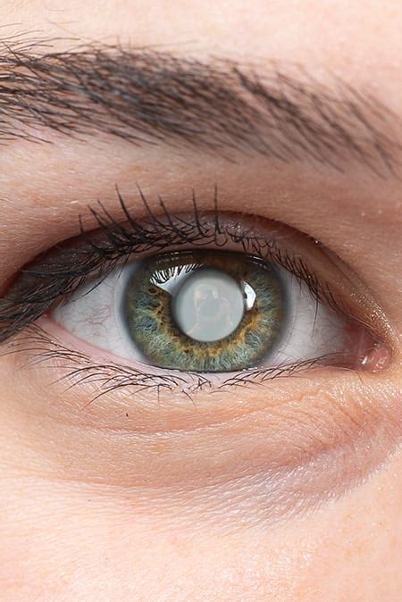 laser eye surgery  management celebration florida