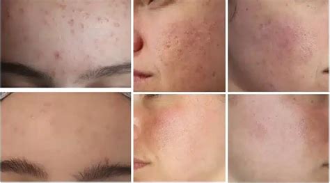 Hydrafacial Paris, La référence Maison Marignan