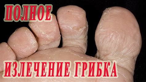 ★Полное ИЗЛЕЧЕНИЕ ГРИБКА между пальцами ног. Препараты и народные ...