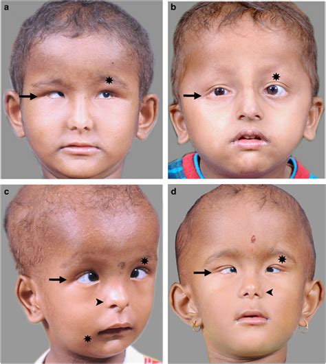 clinical photograph    patients showing presence