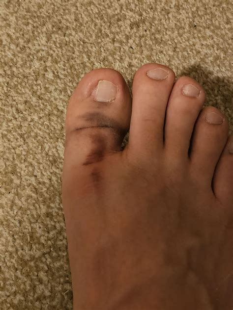 stumbled and jammed my toe into the floor : r/mildlyinfuriating