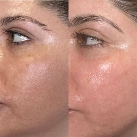 Souirensu It Works: My Before & After Photos Will SHOCK You! - x116409