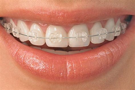 Ceramic Braces - Green Street Dental Practice